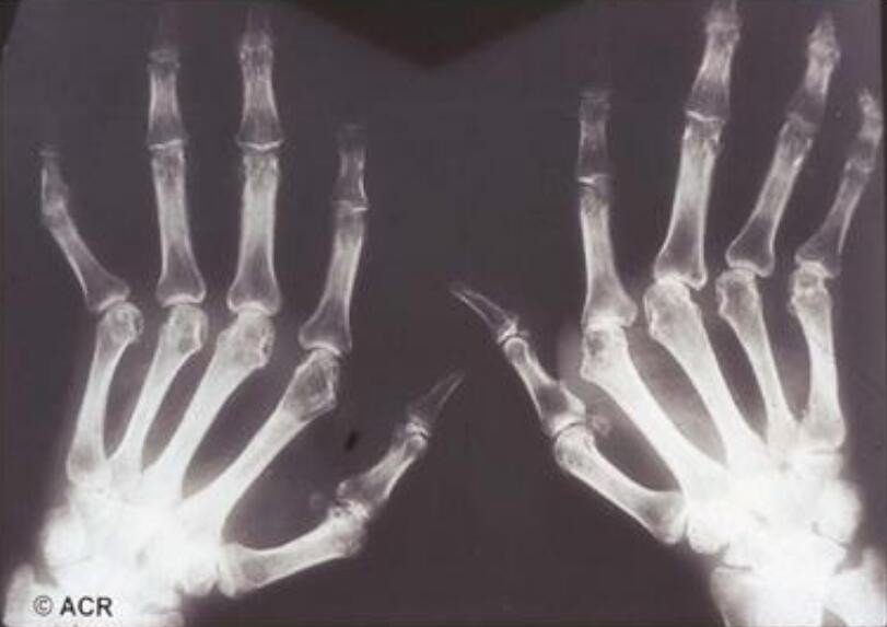 蜂王漿治療風(fēng)濕，有風(fēng)濕能吃蜂蜜和蜂王漿嗎?